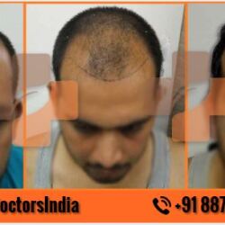 Advance Care Hair Transplant Clinic Kanpur in Tilak Nagar - Best Hair Transplant Clinics in Kanpur - Justdial Advance Care Hair Transplant Clinic Kanpur in Tilak Nagar - Best Hair Transplant Clinics in Kanpur - Justdial