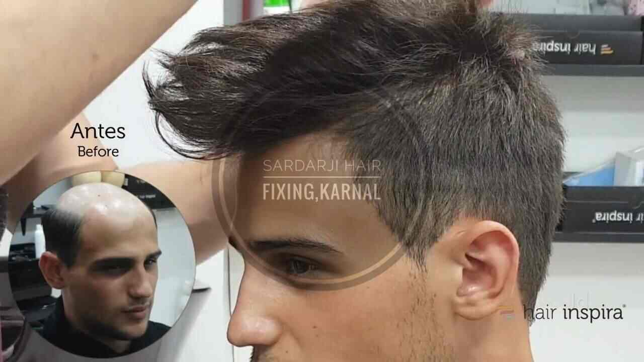 Top Hair Transplant Clinics In Indri Karnal Best Hair