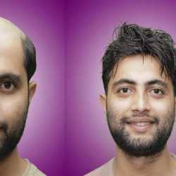 Kolkata Hair Replacement Center in Near Jai Radhe Bhavon.,Kolkata - Best Non Surgical Hair Replacement Services in Kolkata - Justdial Kolkata Hair Replacement Center in Near Jai Radhe Bhavon.,Kolkata - Best Non Surgical Hair Replacement Services in Kolkata - Justdial