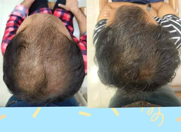 List Of Best Hair Treatment Clinics in Sitapur - Best Hair Loss Treatment -  Justdial