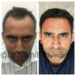 NHT Hair Transplant Clinic In Lucknow in Vivek Khand,Lucknow - Book Appointment Online - Best Hair Transplant Clinics in Lucknow - Justdial NHT Hair Transplant Clinic In Lucknow in Vivek Khand,Lucknow - Book Appointment Online - Best Hair Transplant Clinics in Lucknow - Justdial