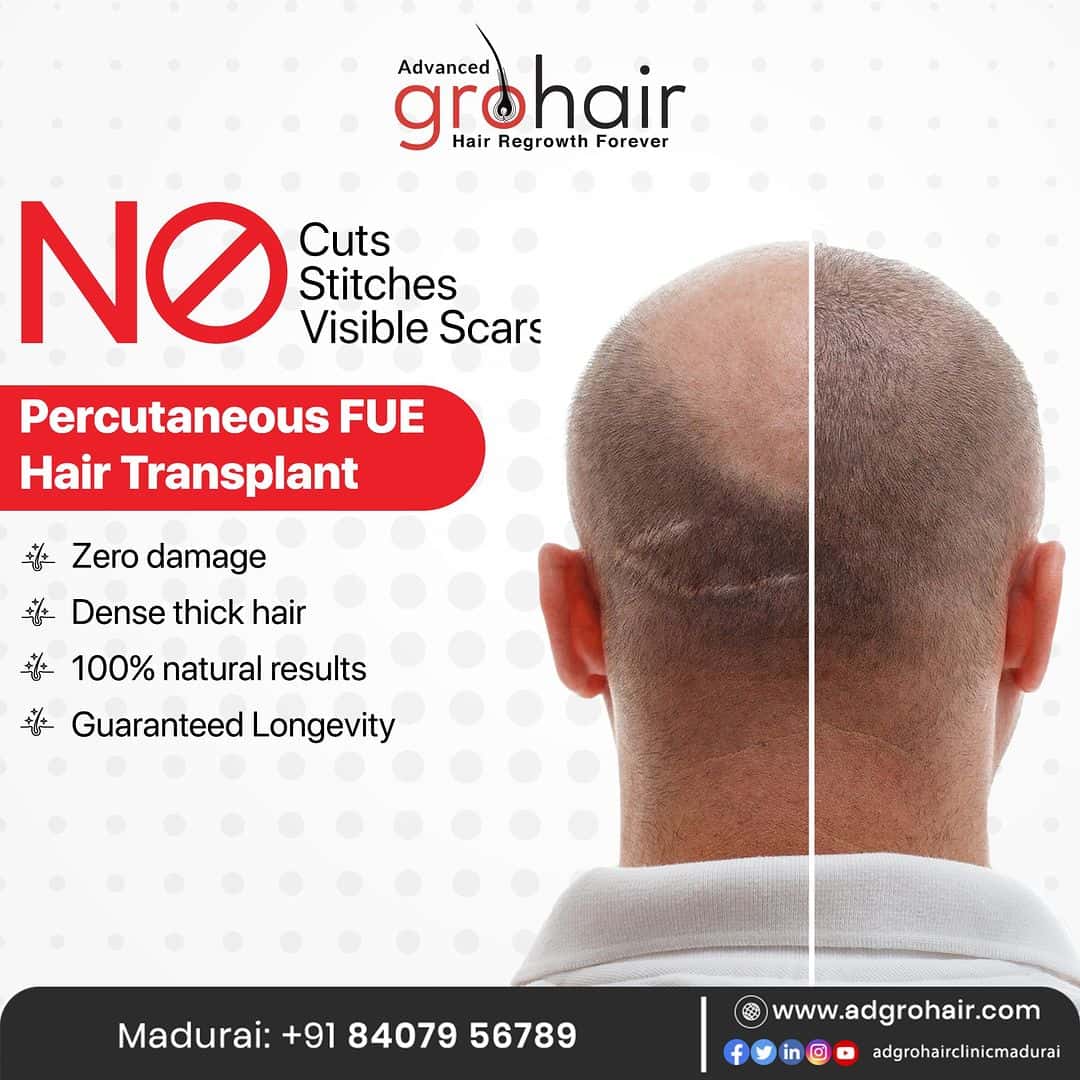 Details 71+ hair transplant in madurai vova.edu.vn