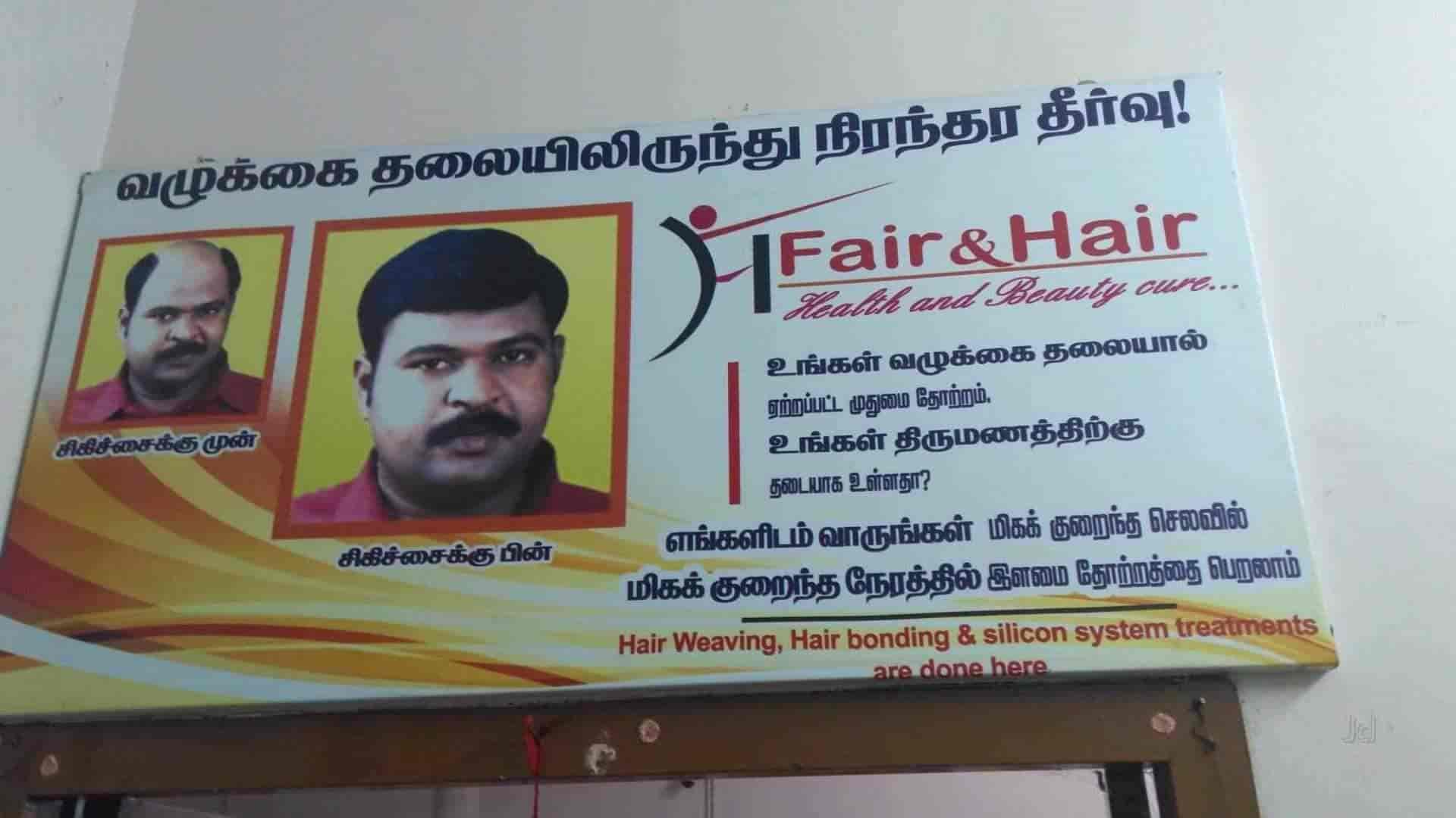 Details 148+ hair transplant in madurai super hot camera.edu.vn