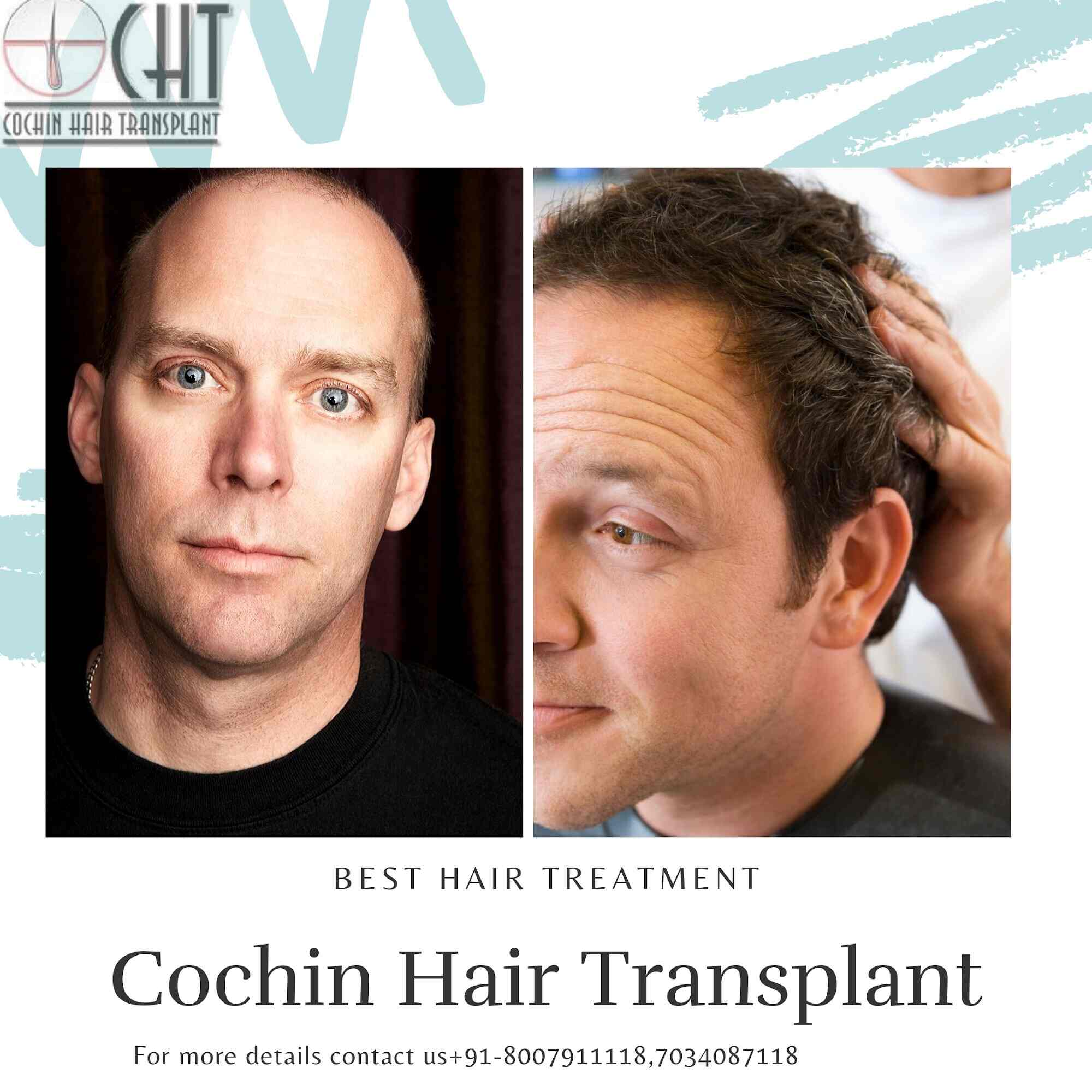 Cochin Hair Transplantation in Perintalmanna - Best Hair Transplant Clinics in Malappuram - Justdial Cochin Hair Transplantation in Perintalmanna - Best Hair Transplant Clinics in Malappuram - Justdial