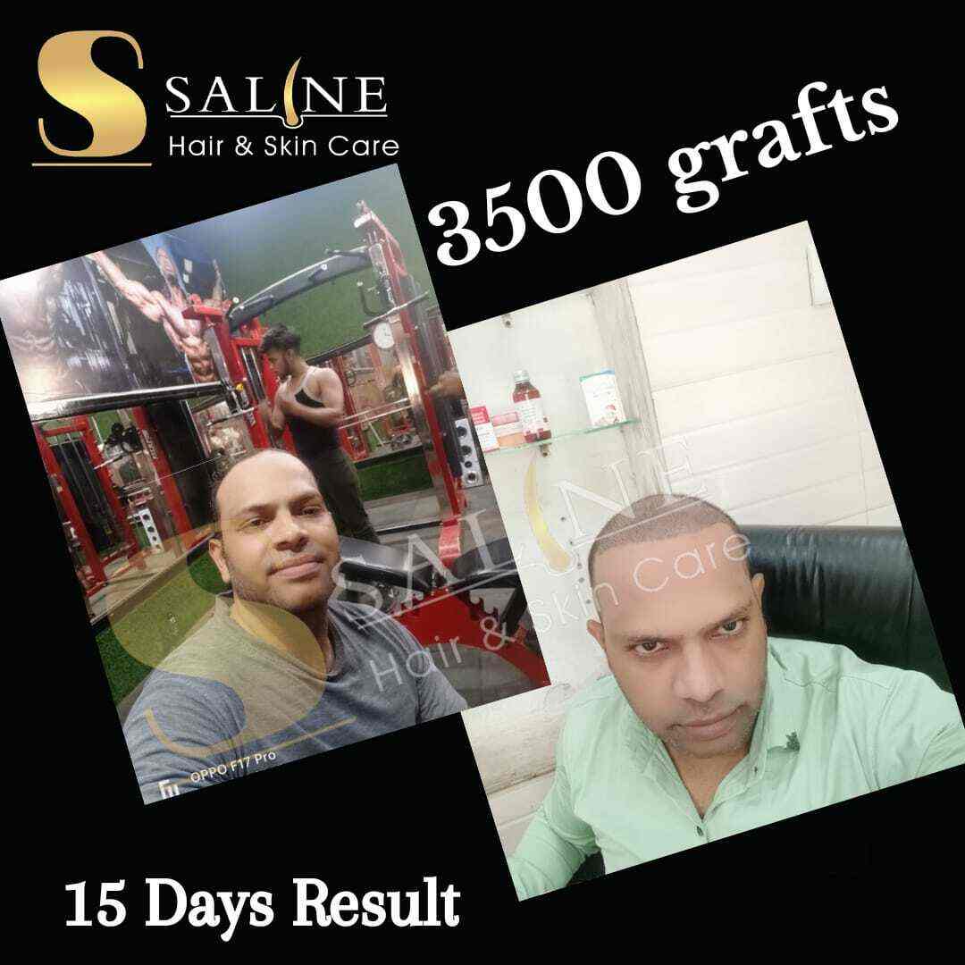 Saline Hair & Skin Care in Hapur Road,Meerut Best Hair Transplant