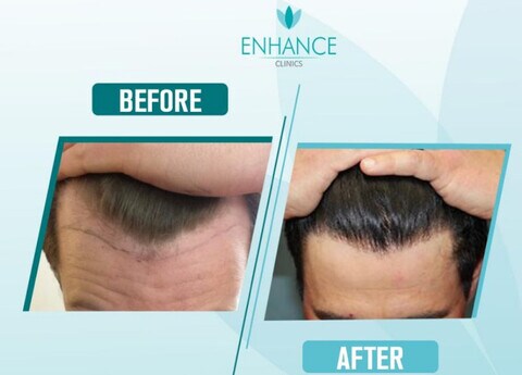 Enhance Clinics in Pedder Road,Mumbai - Best Hair Transplant Clinics in Mumbai - Justdial Enhance Clinics in Pedder Road,Mumbai - Best Hair Transplant Clinics in Mumbai - Justdial