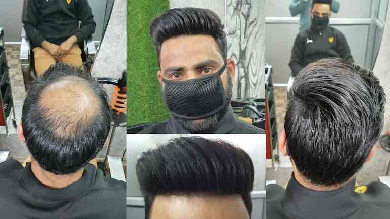 Anas Sheikh Permanent Hair Patch Solution in Andheri East Mumbai