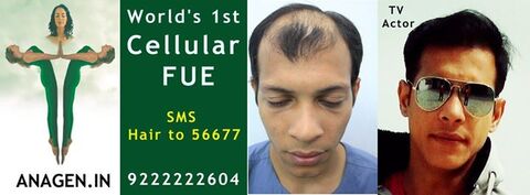 Anagen Hair Transplant in Andheri West - Best Hair Treatment Clinics in Mumbai - Justdial Anagen Hair Transplant in Andheri West - Best Hair Treatment Clinics in Mumbai - Justdial