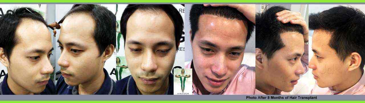 Anagen Hair Transplant Photos, Andheri West, Mumbai- Pictures & Images Gallery - Justdial Anagen Hair Transplant Photos, Andheri West, Mumbai- Pictures & Images Gallery - Justdial