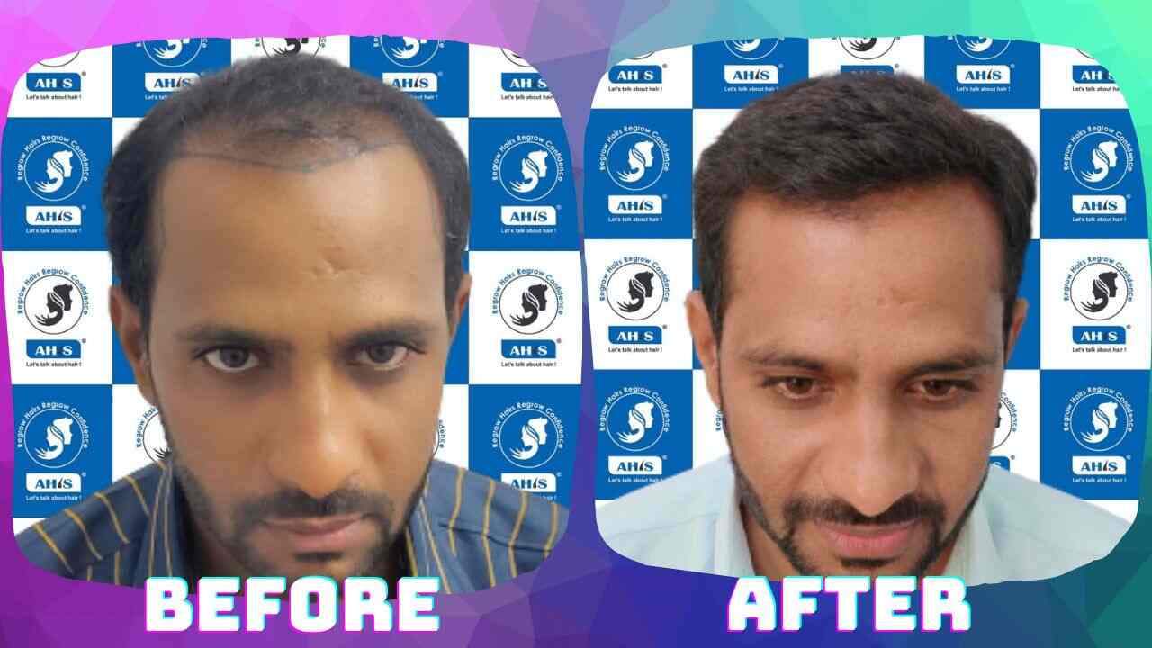 Ahis Advance Hair Implantation Service in Kuvempunagar,Mysore Best