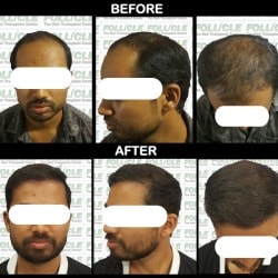 Follicle The Hair Clinic in Nanded Ho,Nanded - Best ENT Doctors in Nanded - Justdial Follicle The Hair Clinic in Nanded Ho,Nanded - Best ENT Doctors in Nanded - Justdial