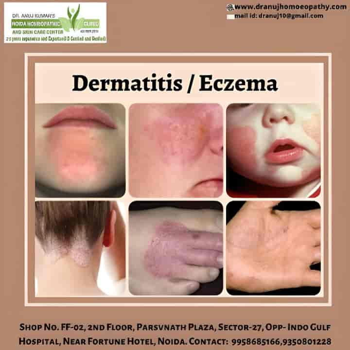 Top Dermatologists in Noida Sector 16, Noida Best Skin Specialist