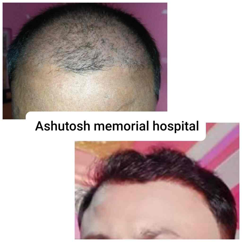 Top Hair Transplant Clinics in Bihar Regimental Centre, Patna - Best Hair Transplant Doctors - Justdial Top Hair Transplant Clinics in Bihar Regimental Centre, Patna - Best Hair Transplant Doctors - Justdial