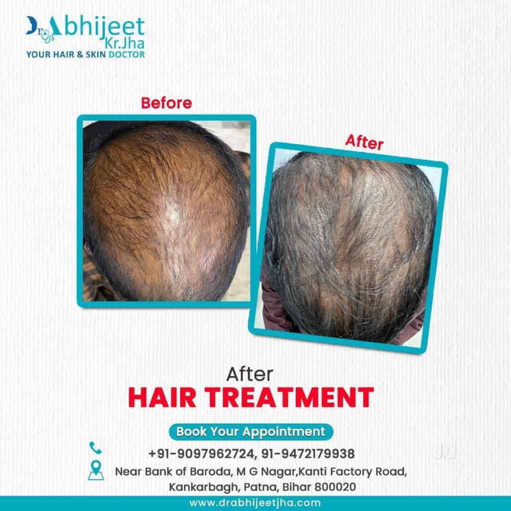 HAIR TREATMENT IN PATNA | ASHUTOSH MEMORIAL HOSPITAL & HAIR TRANSPLANTATION  CENTRE