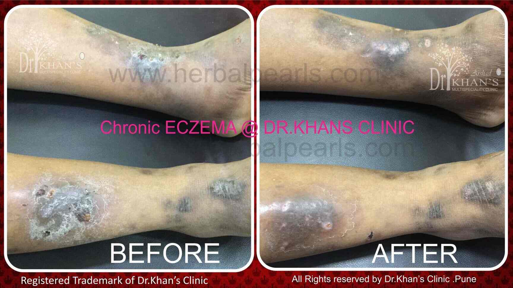 Eczema Clinic in Hadapsar,Pune Best Skin Care Clinics in Pune Justdial