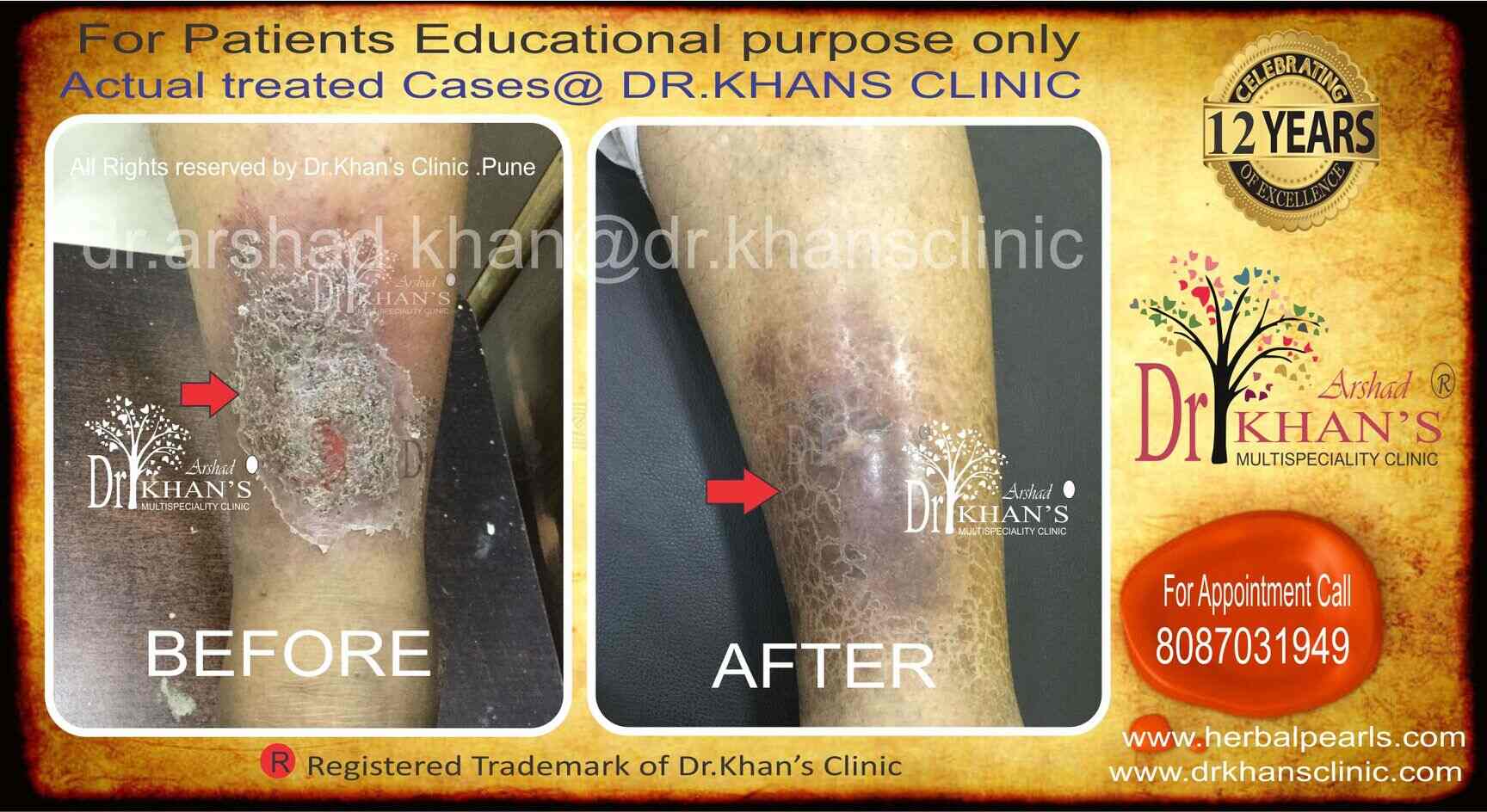 Eczema Clinic in Hadapsar,Pune Best Skin Care Clinics in Pune Justdial