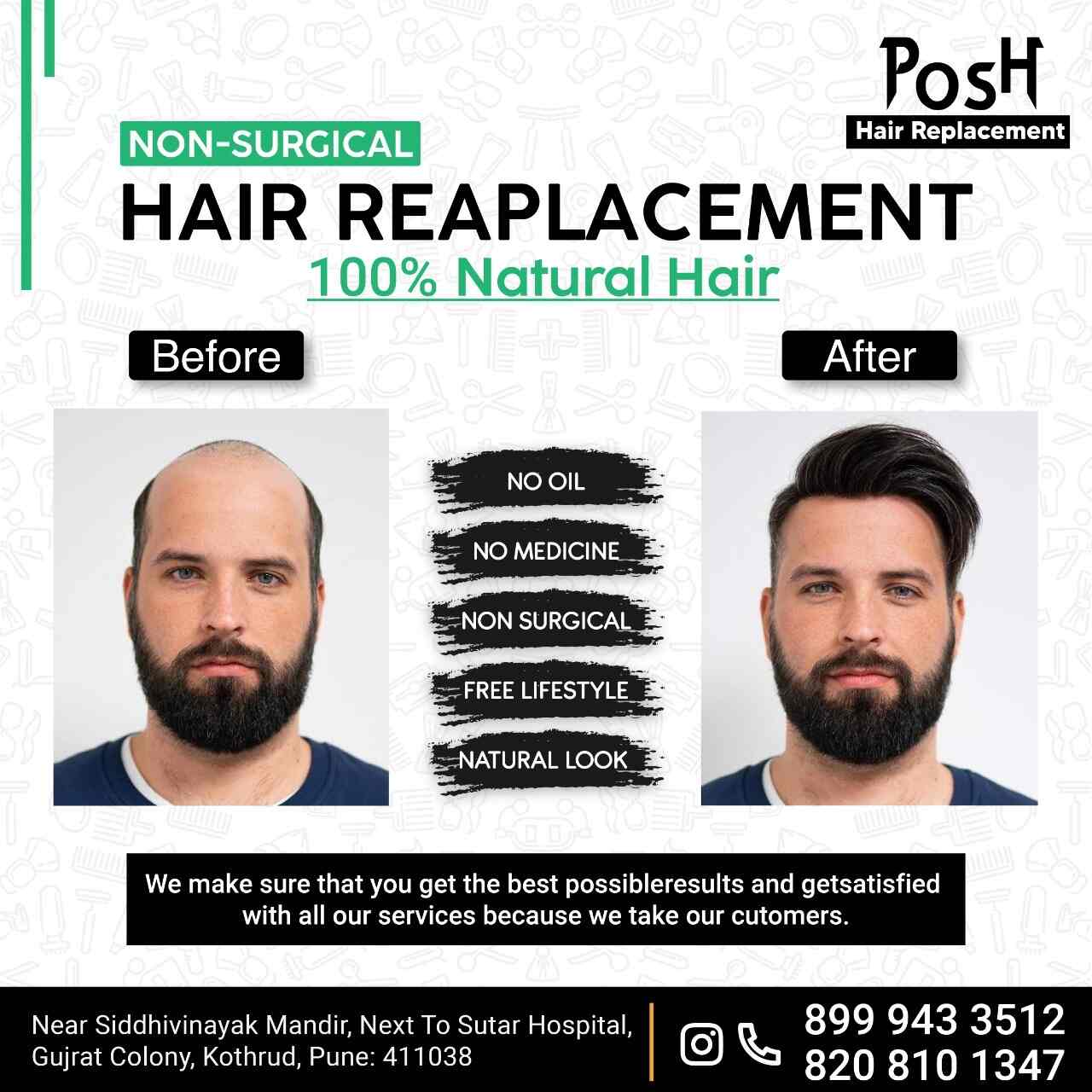 Posh Hair Replacement in Kothrud - Best Hair Transplant Clinics in Pune - Justdial Posh Hair Replacement in Kothrud - Best Hair Transplant Clinics in Pune - Justdial