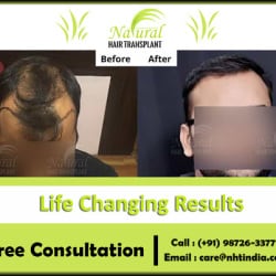 NHT Hair Transplant Clinic in Raipura - Best Hair Transplant Clinics in Raipur-chhattisgarh - Justdial NHT Hair Transplant Clinic in Raipura - Best Hair Transplant Clinics in Raipur-chhattisgarh - Justdial