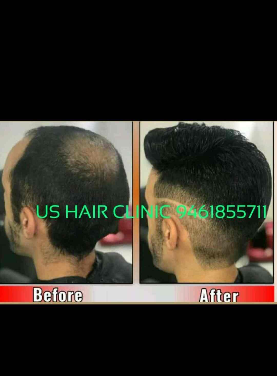 Top Hair Transplant Clinics in Dhundhala, Sojat - Best Hair Transplant Doctors - Justdial Top Hair Transplant Clinics in Dhundhala, Sojat - Best Hair Transplant Doctors - Justdial