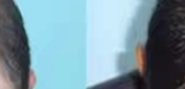 Top Hair Transplant Doctors In Rewa Best Hair Regrowth Treatment