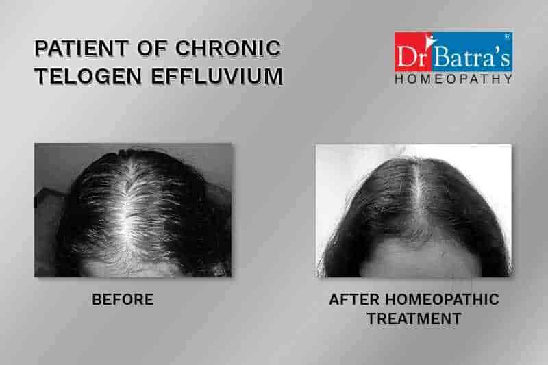 5 Best Advanced Hair Fall/Loss Treatment for Men & Women