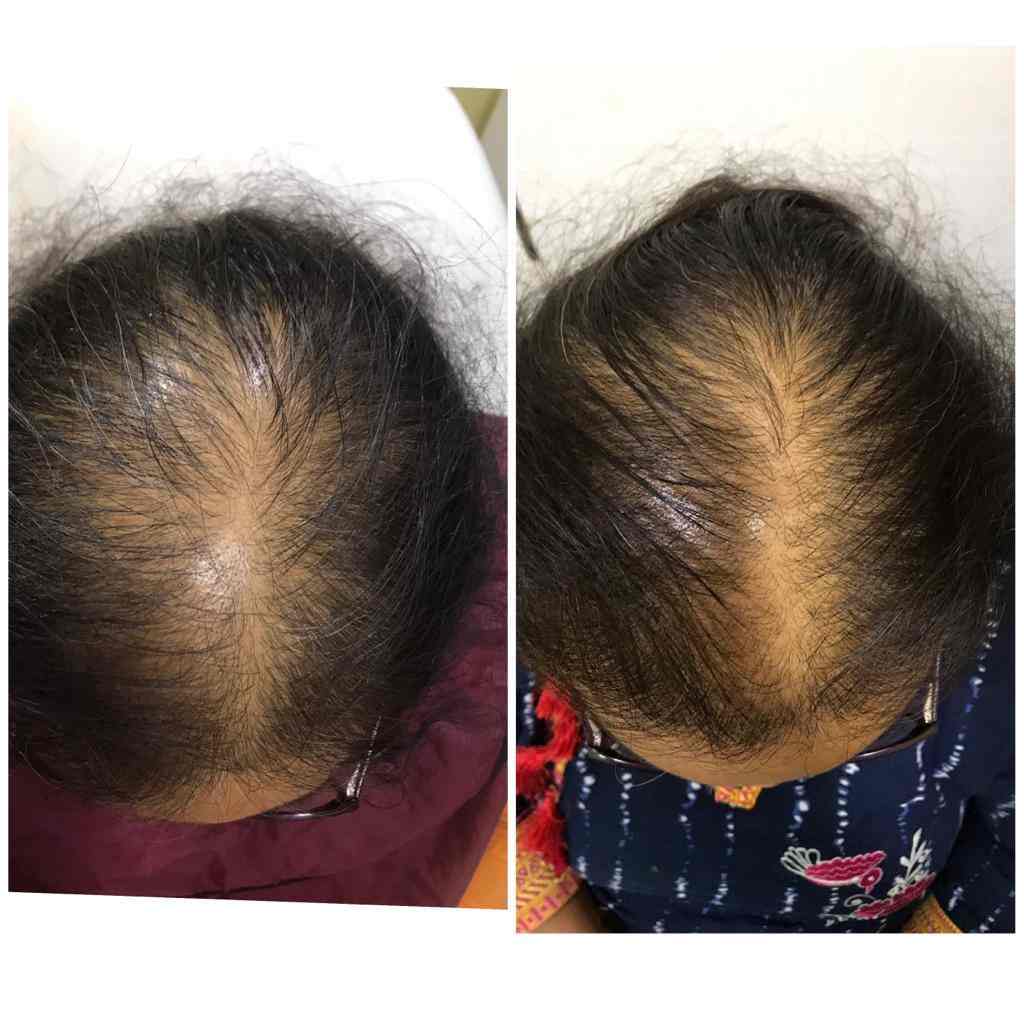 Top Hair Transplant Clinics In Wategaon Sangli Best Hair