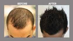 Columbiya Aesthetics in Viman Nagar,Pune - Best Hair Transplant Clinics in Pune - Justdial Columbiya Aesthetics in Viman Nagar,Pune - Best Hair Transplant Clinics in Pune - Justdial