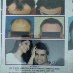 Affordable Hair Transplant in Surat | Hairnimages.com | Best hair transplant,  Fue hair transplant, Hair transplant