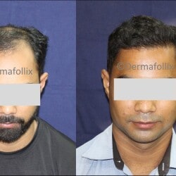 Dermafollix Hair Transplant & Skin Clinic in Athwalines - Book Appointment Online - Best Skin Care Clinics in Surat - Justdial Dermafollix Hair Transplant & Skin Clinic in Athwalines - Book Appointment Online - Best Skin Care Clinics in Surat - Justdial