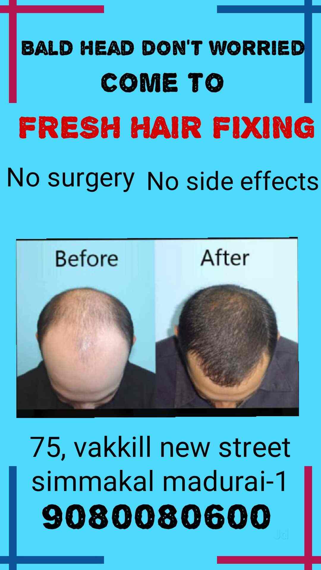 Top Hair Transplant Clinics in Kovilpatti Best Hair Transplant