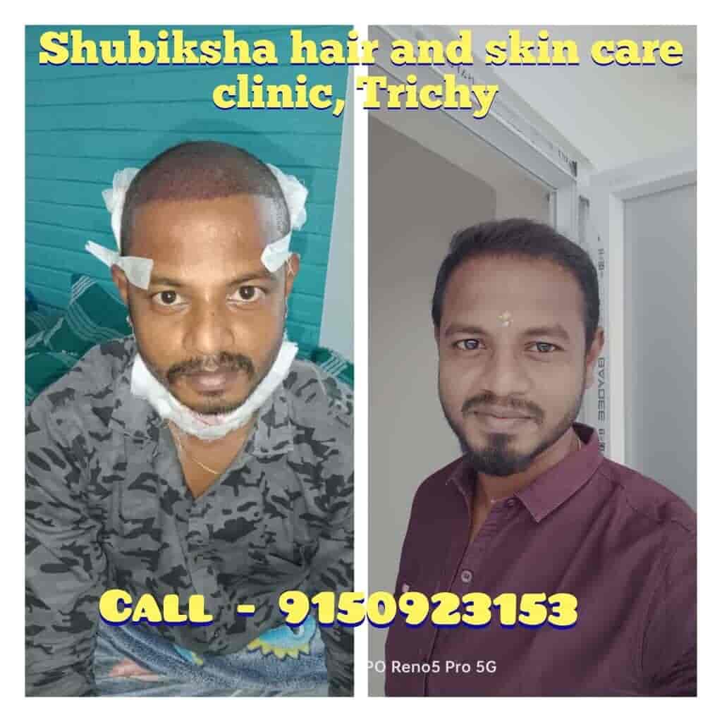 Top Eczema Treatment in Trichy Best Dermatologistseczema Treatment