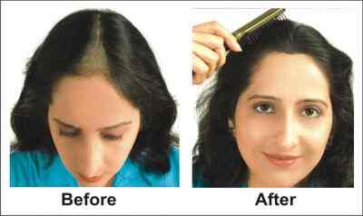 Richfeel Hair and Scalp Clinic Photos, Diwalipura, Vadodara- Pictures & Images Gallery - Justdial Richfeel Hair and Scalp Clinic Photos, Diwalipura, Vadodara- Pictures & Images Gallery - Justdial