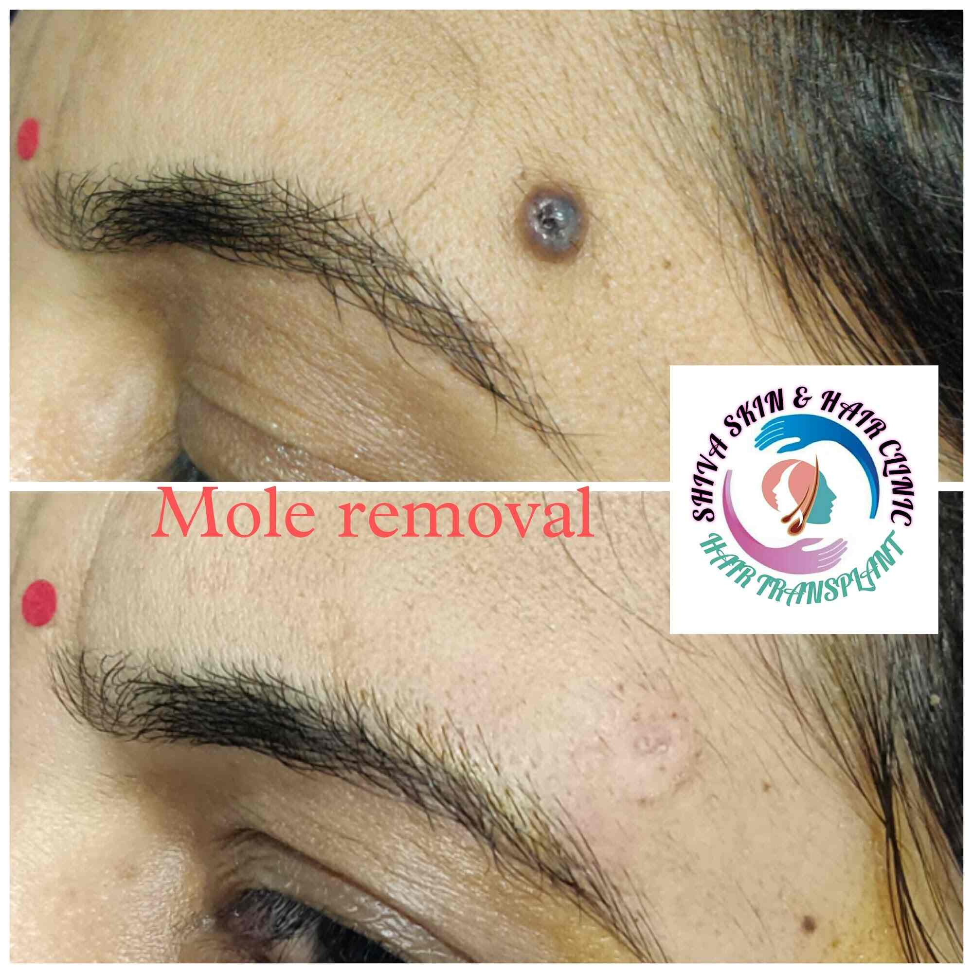 Top 126+ hair transplant in varanasi super hot tnbvietnam.edu.vn