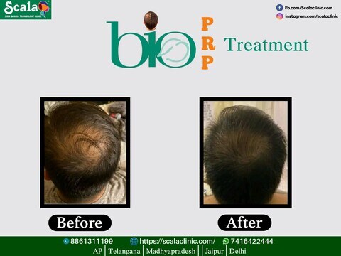 Scala Skin and Hair Transplant in Suryarao Pet,Vijayawada - Best Skin Care Clinics in Vijayawada - Justdial Scala Skin and Hair Transplant in Suryarao Pet,Vijayawada - Best Skin Care Clinics in Vijayawada - Justdial