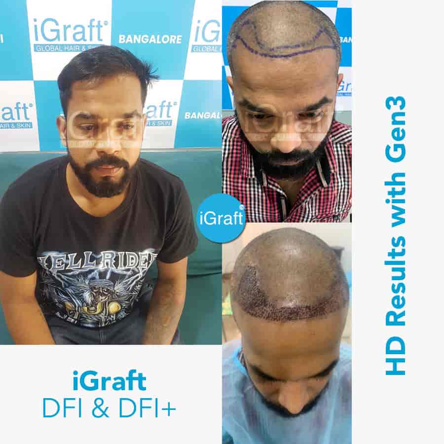 Details 154+ best hair transplant in vijayawada POPPY