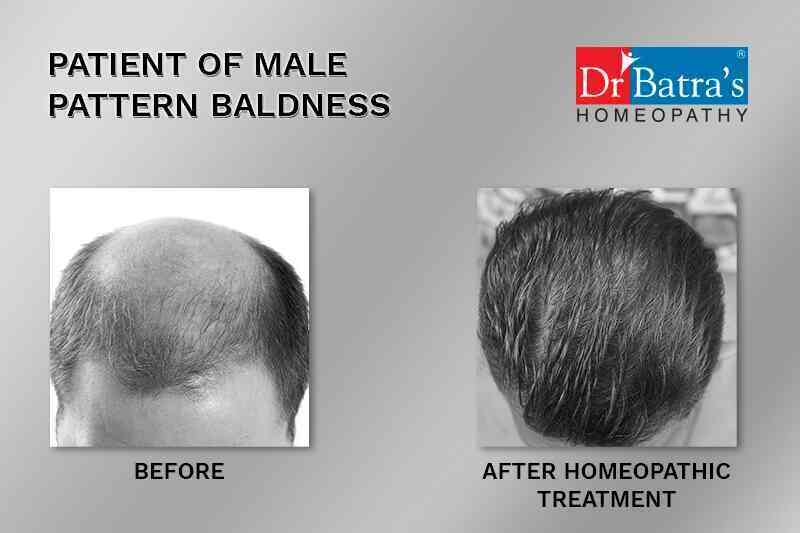 Dr Batra's® New Hair treatment | hair care | Dr Batra's® New Hair treatment  is an FDA-approved hair growth treatment that combines homeopathy and  biological growth factors. A bio-engineered... | By Dr