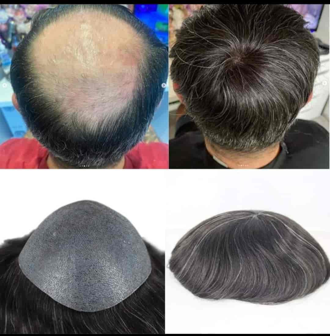 Top Hair Transplant Clinics in Yamunanagar Best Hair Transplant
