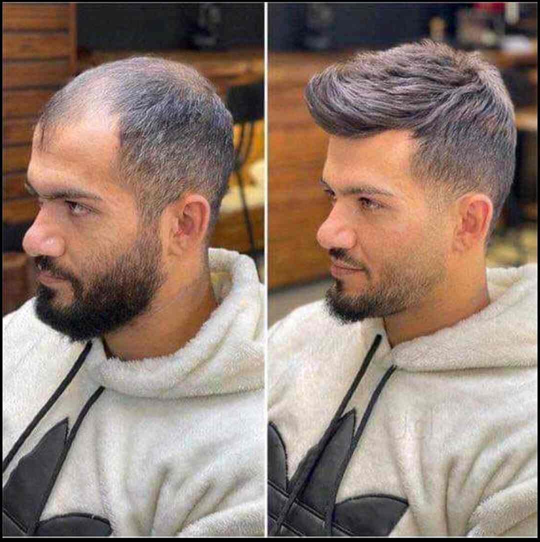 Top Hair Transplant Clinics in Yamunanagar Best Hair Transplant