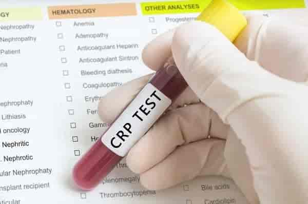 C Reactive Protein (CRP) Test