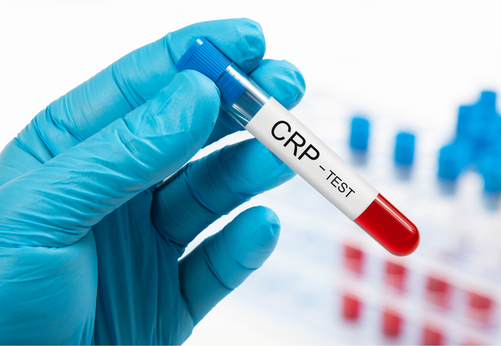 C Reactive Protein (CRP) Test