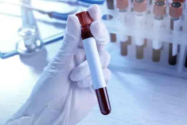 Chikungunya PCR, CSF Test for Men & Women