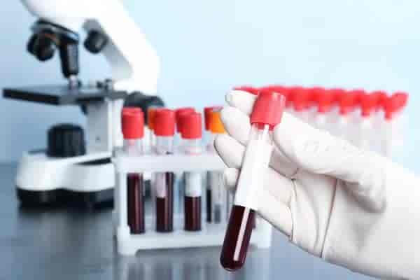 CSF-GeneXpert MTB/RIF Ultra Test for Men & Women