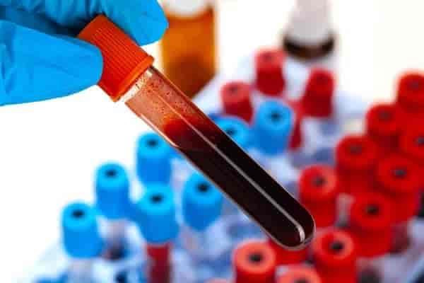 CSF- Gram's Stain Test for Men & Women
