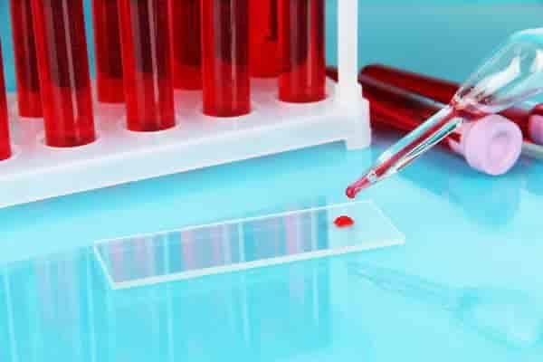 Immunoglobulin (IgG, IgM, IgA), CSF (L) Test for Men & Women