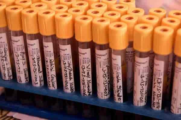 Myelin Basic Protein, CSF (L) Test for Men & Women