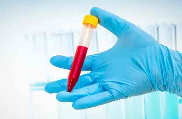Glucose Plasma Test