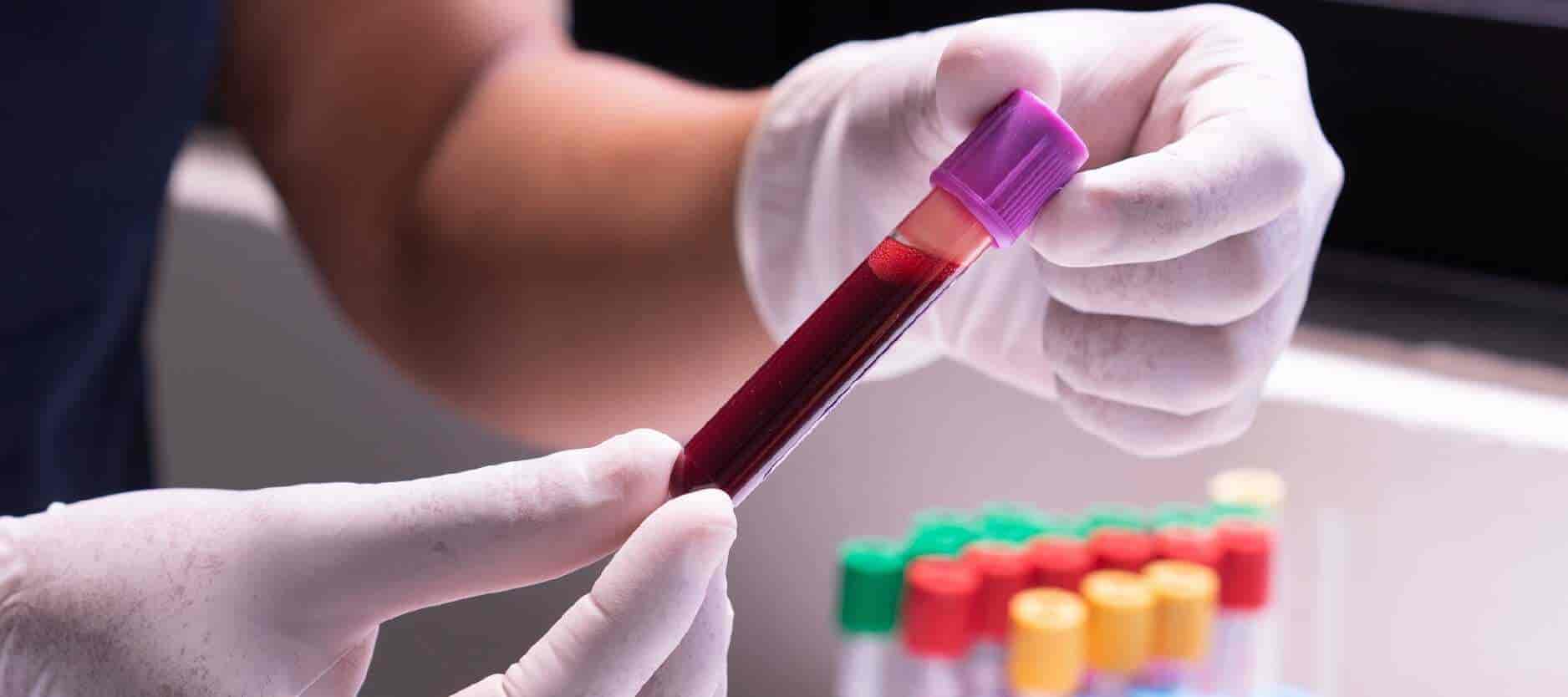 Liver Function Profile