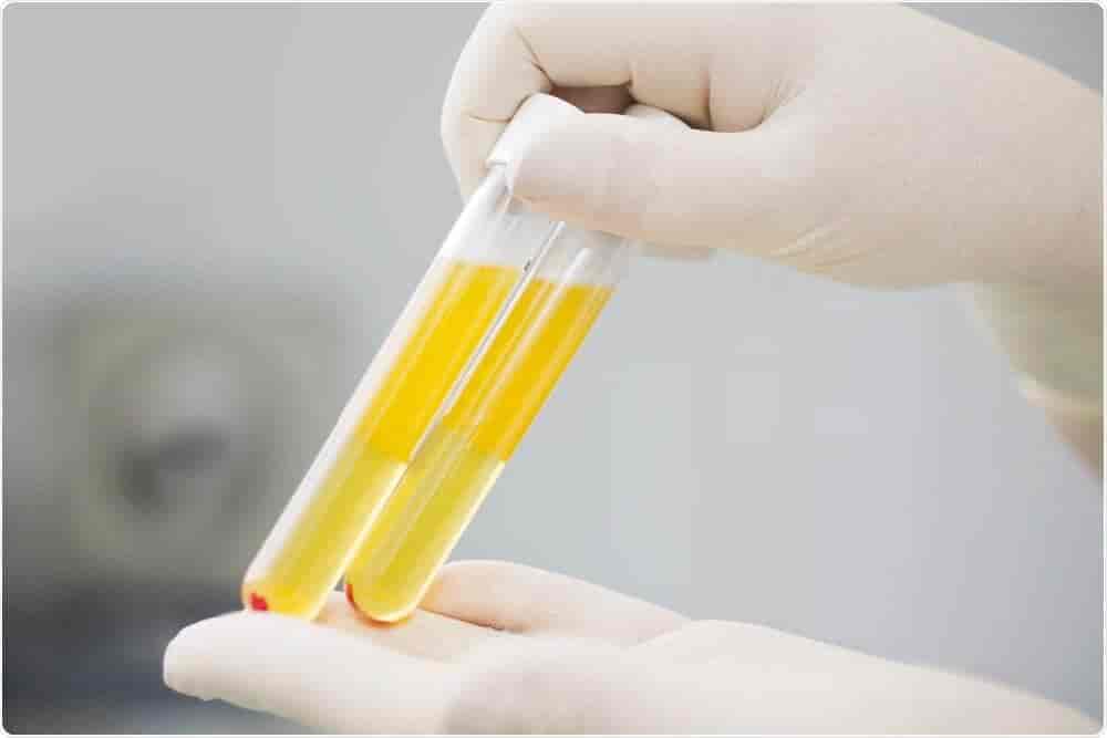 Prothrombin Time Test