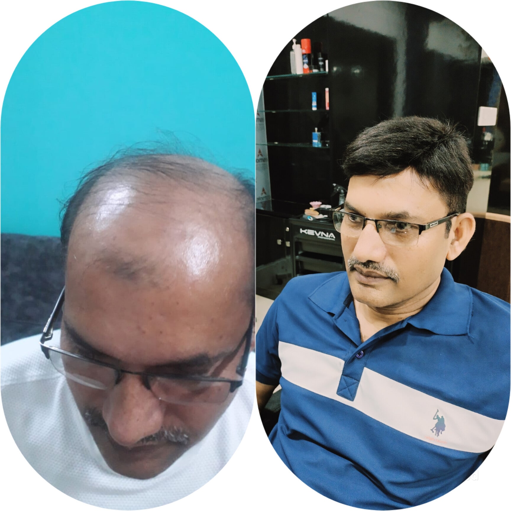 Hair Transplant Hair System Hair Pieces Uk Male 𝐌𝐞𝐧'𝐬 𝐇𝐚𝐢𝐫