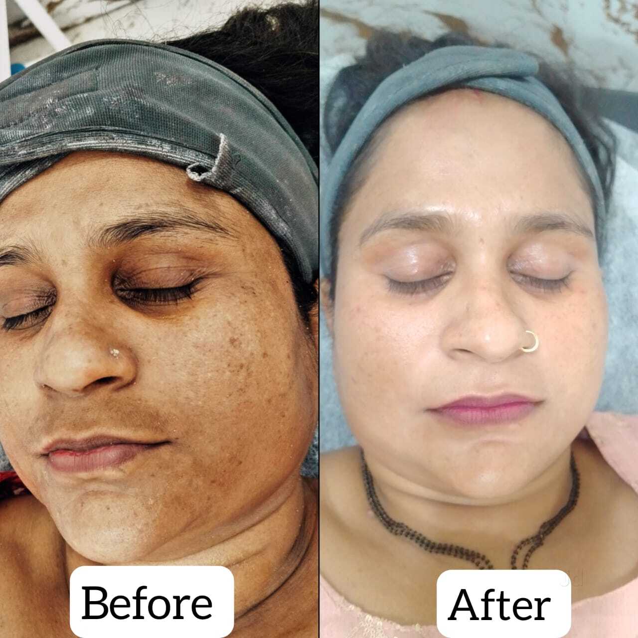 glutathione treatment in bhubaneswar Top Intravenous Services Bhubaneshwar near me Size:30 ml // 1 fl oz 𝐍𝐞𝐰 ! 𝐓𝐚𝐰𝐚𝐬 𝐒𝐨𝐚𝐩✨🍃 n3_antioxidant formulas